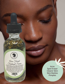 Acne Facial Serum