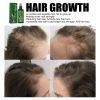 Jaysuing Hair Care Solution Gently Nourishes And Massages Scalp, Moisturizes And Softens Hair Care Spray